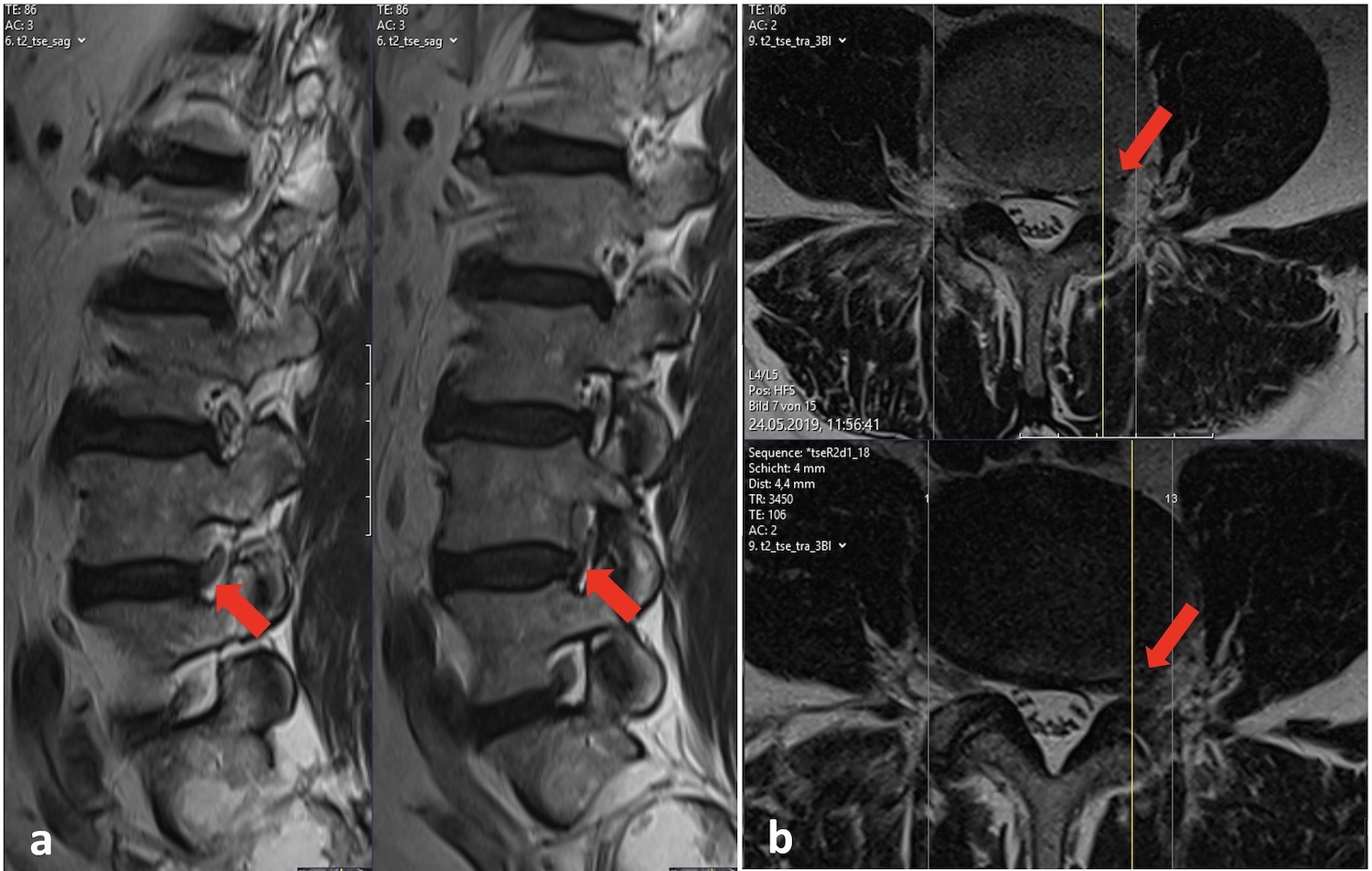 Bandscheibenvorfall an der Lendenwirbelsäule Dr. Burkhardt (Hirslanden)