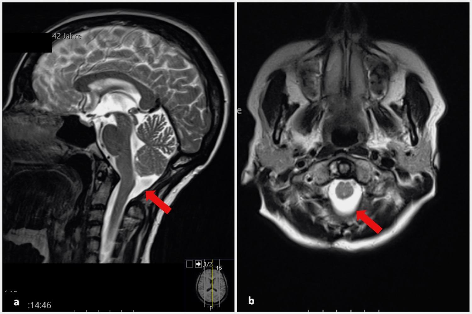 Chiari Malformation Grad Der Behinderung