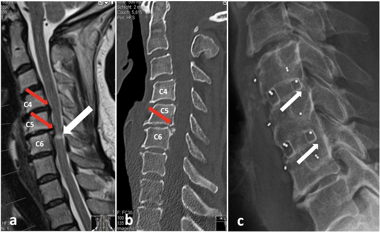 Verengter Halswirbelkanal (Spinalkanalstenose) | Dr. Burkhardt (Zürich)