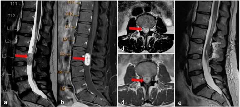 Ist Eine Raumforderung Ein Tumor